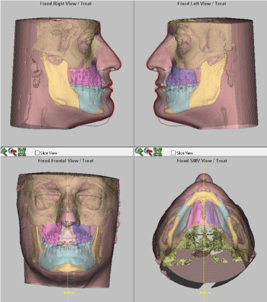 cirugia ortognatica doctor javier martin rodriguez maxilofacial donostia san sebastian eibar gipuzkoa