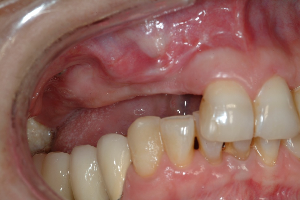 implantes e injertos oseos 2 doctor javier martin rodriguez maxilofacial donostia san sebastian eibar gipuzkoa